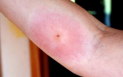 Remédios Caseiros para Picada de Aranha